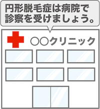 円形脱毛症は病院で治療を！